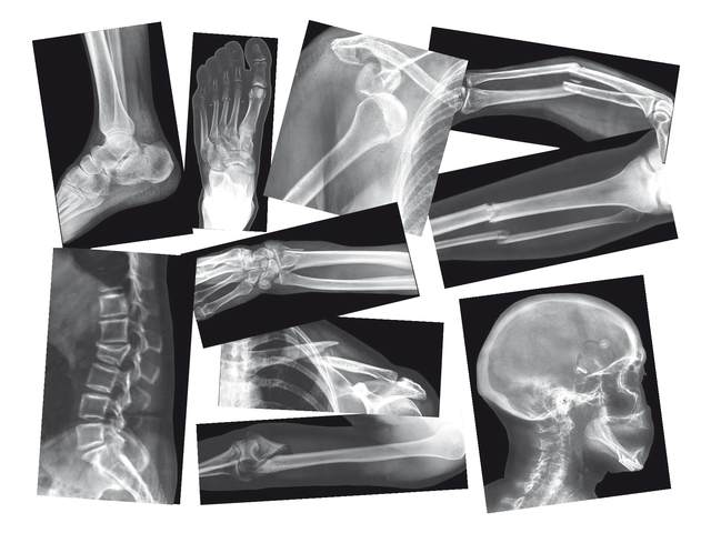 Röntgenképek a törött csontokról